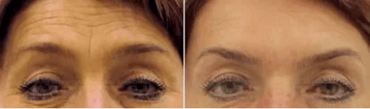 Rejuvenescimento da testa