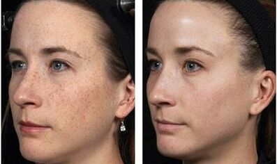 rejuvenescimento facial fracionado antes e depois das fotos