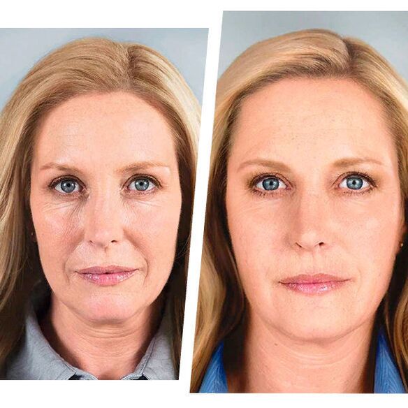 rejuvenescimento antes e depois