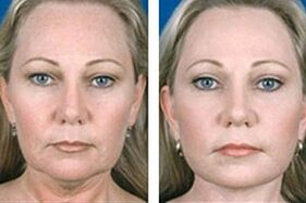 antes e depois do rejuvenescimento facial a laser